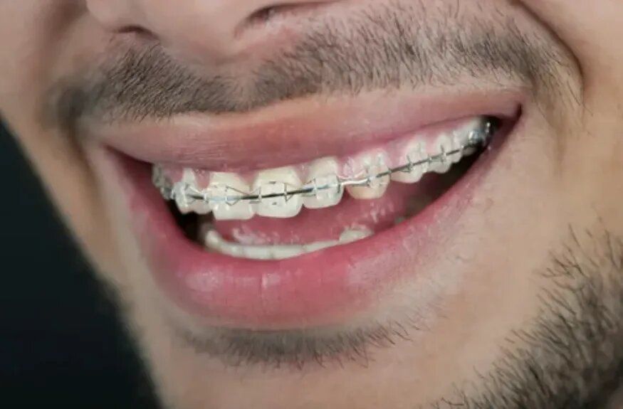 Брекеты и военкомат: Реальная ситуация с призывом граждан с ортодонтическими конструкциями